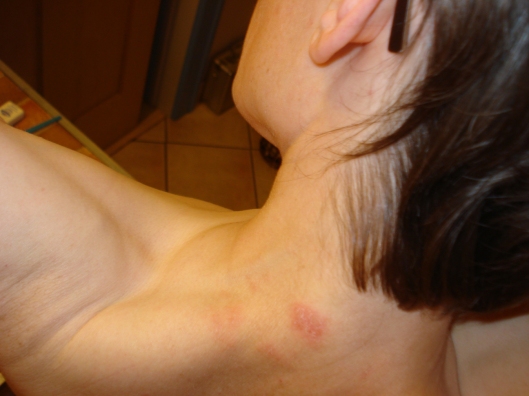 A patch of red on my neck that I had all summer. I thought this was part of the fungal infection, but it flared in a major way after the fungal infection cleared. Apparently it was part of the atopic dermatitis. Sept. 3, 2011.