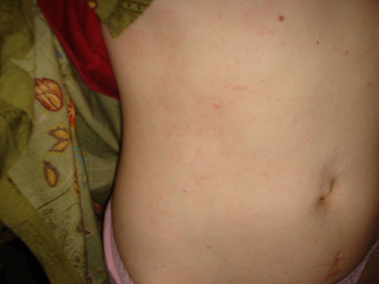 The Generalized Rash: Part I. Differential Diagnosis ...