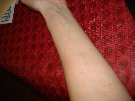 Atopic dermatitis on my arm, Sept. 15, 2011. The rash eventually covered the front and back of my torso, my neck and shoulders, forearms, backs of my knees, and was creeping up my arms.