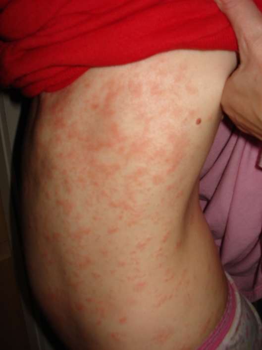 Atopic dermatitis on my torso, Sept. 25, 2011.